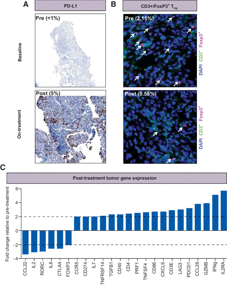 Figure 3. Patient with renal cell carcinoma (RCC) with serial biopsies (pre- and post-treatment) of a liver metastasis that illustrated pharmacodynamic observations consistent with the hypothesized mechanism of action of MOXR0916. Biopsies were stained for the expression of (A) PD-L1 and (B) CD3+/FoxP3+ Treg cells, and assayed for (C) post-treatment tumor gene expression.
