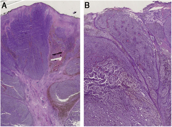 Cauliflower-like exophytic mass on the skin: polypoid melanoma ...