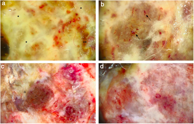 Cauliflower-like exophytic mass on the skin: polypoid melanoma ...