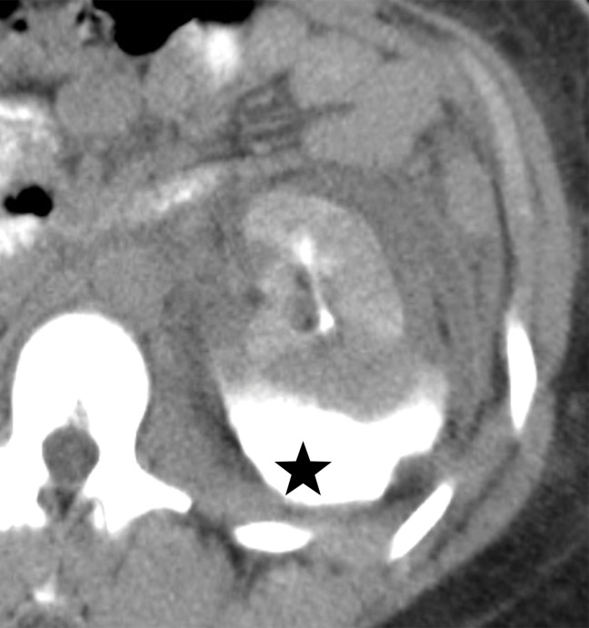 Collecting system injury in a 26-year-old woman with a penetrating injury to the left flank. (a) Axial contrast-enhanced CT image of the abdomen demonstrates multiple left renal lacerations with perinephric hematoma. One of these lacerations approaches the collecting system (arrow), which raises the concern for a collecting system injury. (b) Axial contrast-enhanced delayed phase CT image that was obtained for confirmation demonstrates excretion of the contrast material into the perinephric space (⋆), which is a finding consistent with collecting system renal injury.