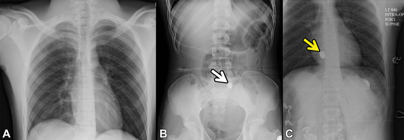 Bullet embolism in a 19-year-old patient who presented to the ED with gunshot trauma and hemodynamic instability. A, B, Anteroposterior radiographic survey images obtained in the trauma bay before exploratory laparotomy demonstrate a bullet projecting over the sacrum (arrow in B ). C, Supine radiograph that was acquired intraoperatively to reveal the position of the bullet after it could not be found in the pelvis shows that the bullet is embolized to the right ventricle (arrow). This imaging finding is direct evidence of vascular injury.