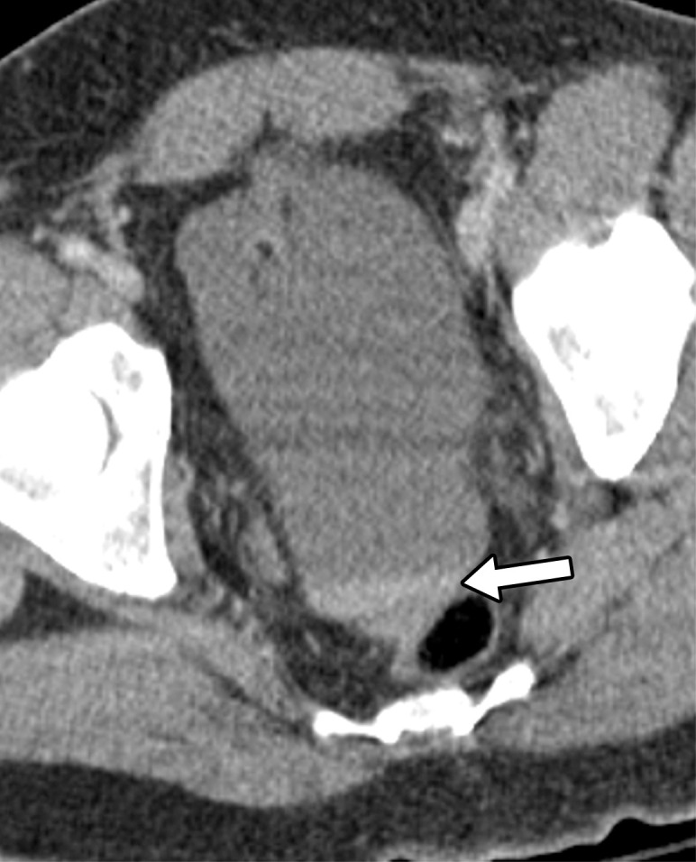 Axial CT images of the abdomen and pelvis in a 38-year-old man with penetrating trauma to the chest and abdomen demonstrate two manifestations of hemoperitoneum with the sentinel clot sign (arrow in a) and the hematocrit effect (arrow in b).