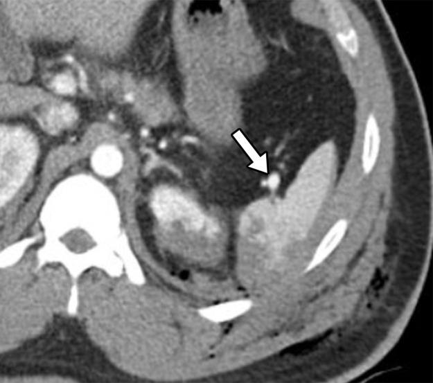 Descriptors of imaging features of splenic injury that may help in grading the splenic trauma, in addition to what has been described with liver injury patterns. Axial CT images demonstrate a shattered spleen (a) and a traumatic pseudoaneurysm (arrow in b).