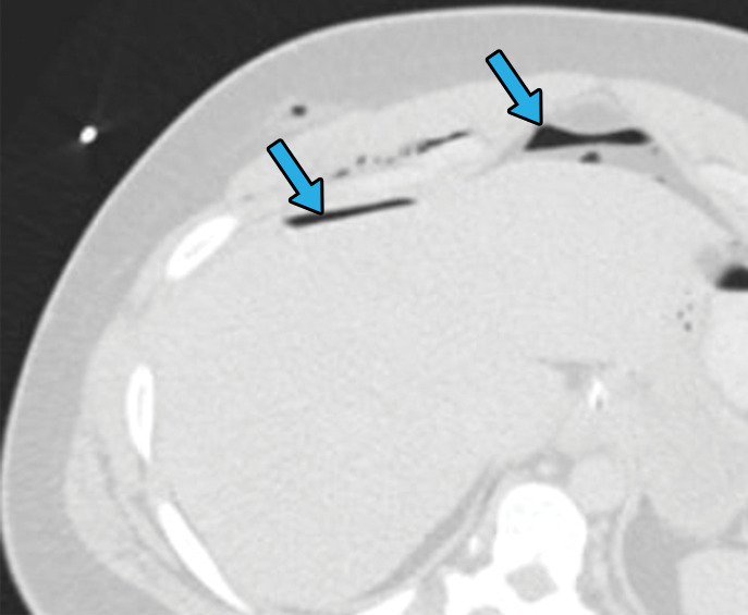 Axial CT images of the abdomen and pelvis with lung window (a) and soft-tissue window (b) in a 24-year-old man who presented with a penetrating gunshot injury demonstrate pneumoperitoneum (blue arrows in a) secondary to cecal injury, as demonstrated by focal bowel wall discontinuity (yellow arrow in b) with adjacent free air (☆ in b).