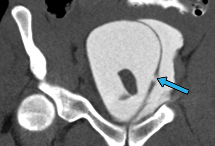 Extraperitoneal bladder injury in a 27-year-old man with a gunshot wound to the right buttock. Axial CT cystograms of the pelvis demonstrate a single bullet within the bladder lumen (yellow arrow in c). There is extraperitoneal extravasation of contrast material from the bladder into the space of Retzius (white arrow in a–c). An extraperitoneal rupture can be seen in the left lateral wall of the bladder (blue arrow in d). The extraluminal contrast material is confined to the pelvic space, which is consistent with a type 4b injury. An intraluminal hematoma can be seen (☆ in b). The patient underwent surgical repair for this extraperitoneal bladder injury during a laparotomy for small bowel injury.