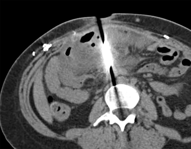 Bowel perforation in a 29-year-old man with a penetrating stab wound by a knife. Axial CT image of the abdomen and pelvis (a) and sagittal reconstruction from CT (b) demonstrate the knife penetrating the mesentery and bowel. There is no question whether bowel or mesenteric trauma exists, even in the absence of free air. The bowel perforation was confirmed at laparotomy.