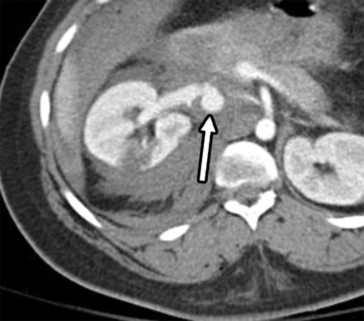 Direct and indirect signs of vascular injury in four patients. (a) Axial contrast-enhanced CT image of the abdomen and pelvis in a 34-year-old woman with a gunshot injury to the right flank demonstrates hematoma (circle) abutting the right renal artery (arrow) with vasospasm, which is suggestive of low-grade injury. (b) Axial contrast-enhanced CT image of the abdomen and pelvis in a 25-year-old man with a stab wound to the posterior flank from a long knife demonstrates right renal laceration with perinephric hematoma and a focal outpouching from the right renal artery (arrow), which are consistent with pseudoaneurysm. (c, d) Axial contrast-enhanced CT images of the abdomen and pelvis in a 19-year-old patient with a gunshot injury to the left back demonstrate hematoma in the retroperitoneum with vascular injuries to the aorta and inferior vena cava (obscured by streak from bullets) with active extravasation (arrow in d), suggesting vascular injury. (e) Axial CT image in a 27-year-old man with a gunshot injury to the right lateral abdomen (entry wound shown with solid orange oval) depicts a trajectory superimposed on the image (arrow) that traverses through the aorta and inferior vena cava, causing an arteriovenous fistula (dashed yellow oval).