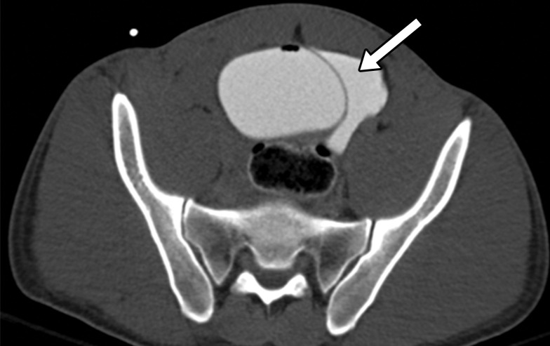 Extraperitoneal bladder injury in a 27-year-old man with a gunshot wound to the right buttock. Axial CT cystograms of the pelvis demonstrate a single bullet within the bladder lumen (yellow arrow in c). There is extraperitoneal extravasation of contrast material from the bladder into the space of Retzius (white arrow in a–c). An extraperitoneal rupture can be seen in the left lateral wall of the bladder (blue arrow in d). The extraluminal contrast material is confined to the pelvic space, which is consistent with a type 4b injury. An intraluminal hematoma can be seen (☆ in b). The patient underwent surgical repair for this extraperitoneal bladder injury during a laparotomy for small bowel injury.