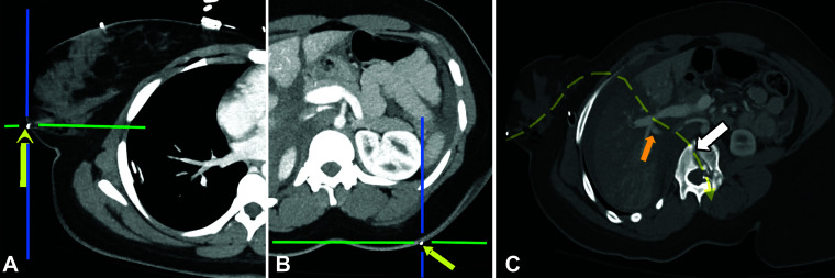 Lower chest and abdominal gunshot wound in a 27-year-old woman. A, B, Axial CT trajectograms depict the external BBs marking the entry wound in the right breast (arrow in A) and the exit wound in the dorsal left midback (arrow in B). After localizing the entry and exit wounds, the cut planes are swiveled obliquely in orthogonal planes to obtain a double-oblique orientation in which the wound track is visualized in profile. These points are used to create a curved multiplanar reconstruction. C, Curved multiplanar reconstruction from CT that was created along the pathway of the ballistic injury (dashed yellow arrow) demonstrates soft-tissue gas in the right breast (there was no intrathoracic or diaphragmatic violation), portal vein confluence extravasation centered in the grade V liver injury (orange arrow), and an L1 burst fracture (white arrow). The exit wound metallic marker (not shown) was located one section above that shown in C.