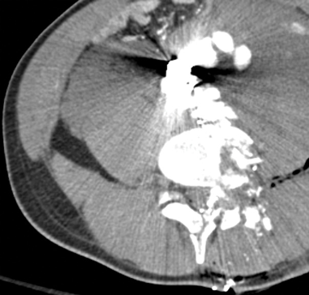 Direct and indirect signs of vascular injury in four patients. (a) Axial contrast-enhanced CT image of the abdomen and pelvis in a 34-year-old woman with a gunshot injury to the right flank demonstrates hematoma (circle) abutting the right renal artery (arrow) with vasospasm, which is suggestive of low-grade injury. (b) Axial contrast-enhanced CT image of the abdomen and pelvis in a 25-year-old man with a stab wound to the posterior flank from a long knife demonstrates right renal laceration with perinephric hematoma and a focal outpouching from the right renal artery (arrow), which are consistent with pseudoaneurysm. (c, d) Axial contrast-enhanced CT images of the abdomen and pelvis in a 19-year-old patient with a gunshot injury to the left back demonstrate hematoma in the retroperitoneum with vascular injuries to the aorta and inferior vena cava (obscured by streak from bullets) with active extravasation (arrow in d), suggesting vascular injury. (e) Axial CT image in a 27-year-old man with a gunshot injury to the right lateral abdomen (entry wound shown with solid orange oval) depicts a trajectory superimposed on the image (arrow) that traverses through the aorta and inferior vena cava, causing an arteriovenous fistula (dashed yellow oval).