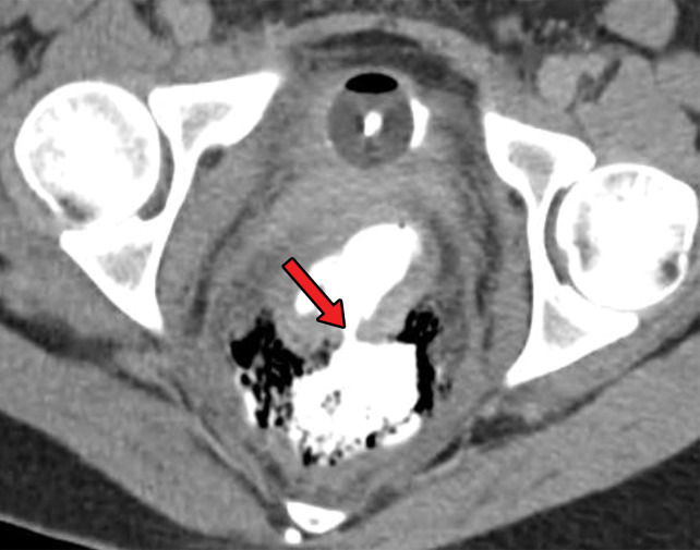 Axial CT images with intravenous contrast material obtained before (a) and after (b) the administration of rectal contrast material in a 27-year-old man with penetrating rectal trauma from a foreign body show a transmural defect (red arrow) with a focal collection of free air (white arrow in a) that was confirmed with rectal contrast material, demonstrating extraluminal leakage through the defect in b.