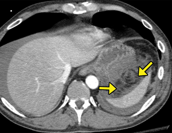 Multiple gunshot wounds with pancreatic transection in a 40-year-old man. (a) Axial contrast-enhanced CT image of the abdomen and pelvis demonstrates pancreatic laceration (red arrows) with active extravasation (white arrow), indicating direct signs of pancreatic injury. (b) Axial contrast-enhanced CT image shows extensive peripancreatic stranding extending toward the splenic hilum (yellow arrows), which is an indirect sign of pancreatic injury.