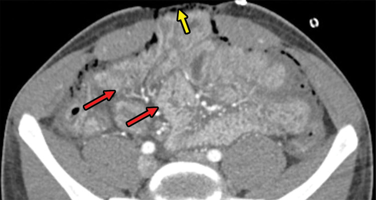 Multiple gunshot-related injuries in a 21-year-old patient who was taken to the operating room for initial exploratory laparotomy. Axial CT images reveal packing material (green arrow in a) with an open abdomen (yellow arrow in b). The image obtained after surgical exploration (b) demonstrates thickened bowel walls with hyperenhancement (red arrows), which are likely secondary to hypoperfusion. A bleeding pseudoaneurysm (blue arrow in a) in hepatic segment 7 is demonstrated, which was subsequently coil embolized (not shown). Also note segmental liver infarctions (white arrows in a) and large-volume hematoma (☆ in a). This finding (bleeding pseudoaneurysm) was not appreciated at exploratory laparotomy.