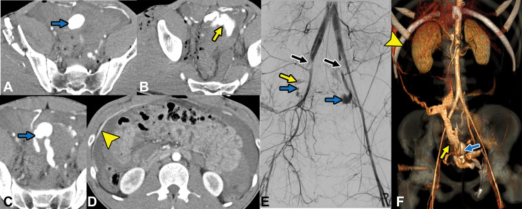 Gunshot trauma in a 20-year-old patient. A–D, Axial CT images demonstrate multiple gunshot pelvic fractures with resultant large pseudoaneurysm (blue arrows) and active extravasation (yellow arrow) with blood extending into the right upper quadrant (arrowhead in D). E, Catheter angiogram demonstrates pseudoaneurysms (blue arrows) with areas of active extravasation (yellow arrow). Also note arterial spasm due to ongoing active bleeding (black arrows). F, Coronal three-dimensional volume-rendered image demonstrates pseudoaneurysm (blue arrow) and active extravasation (yellow arrow) with blood extending into the right upper quadrant (arrowhead).