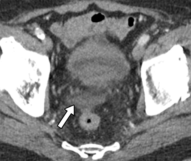 Axial contrast-enhanced CT images of the abdomen and pelvis in a 56-year-old man with gunshot trauma to the abdomen show simple attenuating free fluid (arrow) in the dependent portions, which are the cul-de-sac (a) and Morison pouch (b).