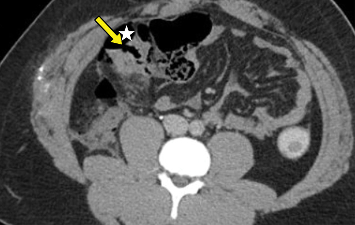 Axial CT images of the abdomen and pelvis with lung window (a) and soft-tissue window (b) in a 24-year-old man who presented with a penetrating gunshot injury demonstrate pneumoperitoneum (blue arrows in a) secondary to cecal injury, as demonstrated by focal bowel wall discontinuity (yellow arrow in b) with adjacent free air (☆ in b).