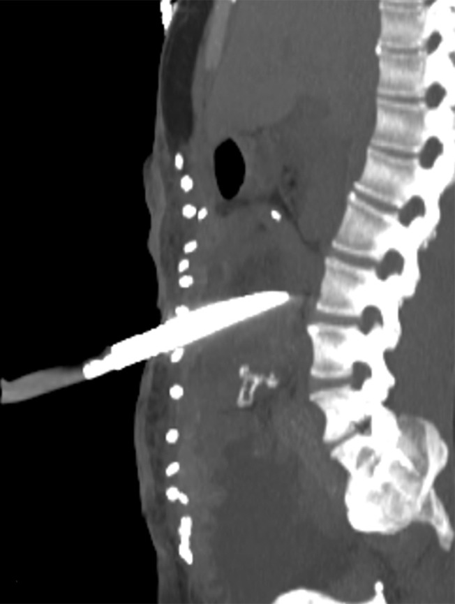 Bowel perforation in a 29-year-old man with a penetrating stab wound by a knife. Axial CT image of the abdomen and pelvis (a) and sagittal reconstruction from CT (b) demonstrate the knife penetrating the mesentery and bowel. There is no question whether bowel or mesenteric trauma exists, even in the absence of free air. The bowel perforation was confirmed at laparotomy.