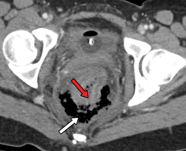 Axial CT images with intravenous contrast material obtained before (a) and after (b) the administration of rectal contrast material in a 27-year-old man with penetrating rectal trauma from a foreign body show a transmural defect (red arrow) with a focal collection of free air (white arrow in a) that was confirmed with rectal contrast material, demonstrating extraluminal leakage through the defect in b.