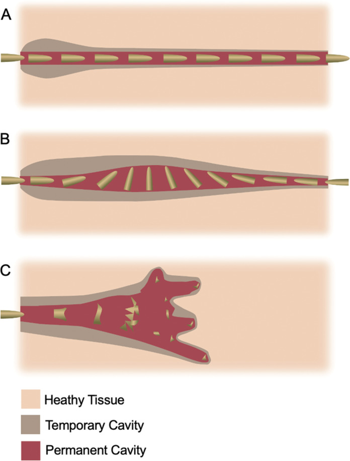 Wound ballistics refers to terminal ballistics in tissues. Penetrating injuries, A, can generate temporary and permanent cavities. Trajectory and kinetics, including yaw or tumbling, B, and projectile deformation and fragmentation, C, within tissues can affect cavity dimensions.