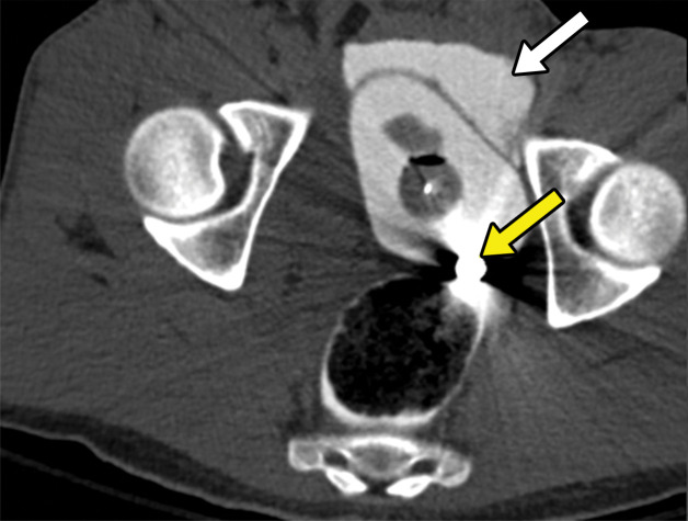 Extraperitoneal bladder injury in a 27-year-old man with a gunshot wound to the right buttock. Axial CT cystograms of the pelvis demonstrate a single bullet within the bladder lumen (yellow arrow in c). There is extraperitoneal extravasation of contrast material from the bladder into the space of Retzius (white arrow in a–c). An extraperitoneal rupture can be seen in the left lateral wall of the bladder (blue arrow in d). The extraluminal contrast material is confined to the pelvic space, which is consistent with a type 4b injury. An intraluminal hematoma can be seen (☆ in b). The patient underwent surgical repair for this extraperitoneal bladder injury during a laparotomy for small bowel injury.