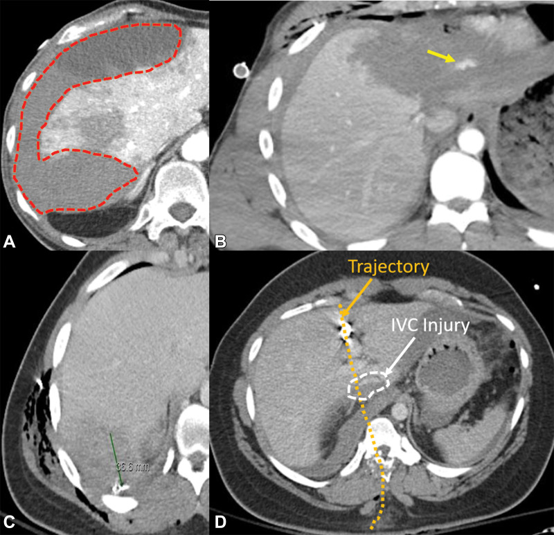 Description of various imaging features that may help in grading liver injury. Axial CT images depict hematoma (orange outline in A), active extravasation (arrow in B), laceration (green line indicating ruler in C), and juxtavenous injury (white arrow and dashed circle in D). The trajectory is superimposed (orange arrow and orange dotted line in D). IVC = inferior vena cava.