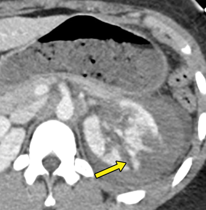 Collecting system injury in a 26-year-old woman with a penetrating injury to the left flank. (a) Axial contrast-enhanced CT image of the abdomen demonstrates multiple left renal lacerations with perinephric hematoma. One of these lacerations approaches the collecting system (arrow), which raises the concern for a collecting system injury. (b) Axial contrast-enhanced delayed phase CT image that was obtained for confirmation demonstrates excretion of the contrast material into the perinephric space (⋆), which is a finding consistent with collecting system renal injury.