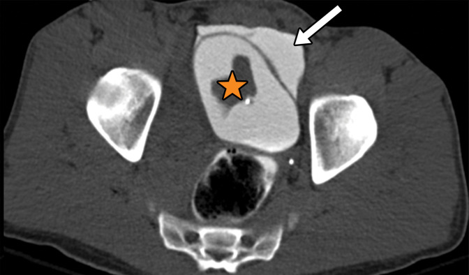 Extraperitoneal bladder injury in a 27-year-old man with a gunshot wound to the right buttock. Axial CT cystograms of the pelvis demonstrate a single bullet within the bladder lumen (yellow arrow in c). There is extraperitoneal extravasation of contrast material from the bladder into the space of Retzius (white arrow in a–c). An extraperitoneal rupture can be seen in the left lateral wall of the bladder (blue arrow in d). The extraluminal contrast material is confined to the pelvic space, which is consistent with a type 4b injury. An intraluminal hematoma can be seen (☆ in b). The patient underwent surgical repair for this extraperitoneal bladder injury during a laparotomy for small bowel injury.