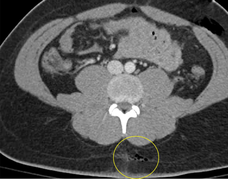 Gunshot injury in a 21-year-old man. Axial contrast-enhanced CT images of the abdomen and pelvis demonstrate foci of gas within the subcutaneous fat, indicating the entry wound (yellow circle in a) and exit wound (red oval in b). In the path of the bullet trajectory (not double oblique orientation), there is evidence of bowel injury, as indicated by focal bowel wall thickening and surrounding stranding (yellow circle in b), which is magnified for clarity (inset in b).