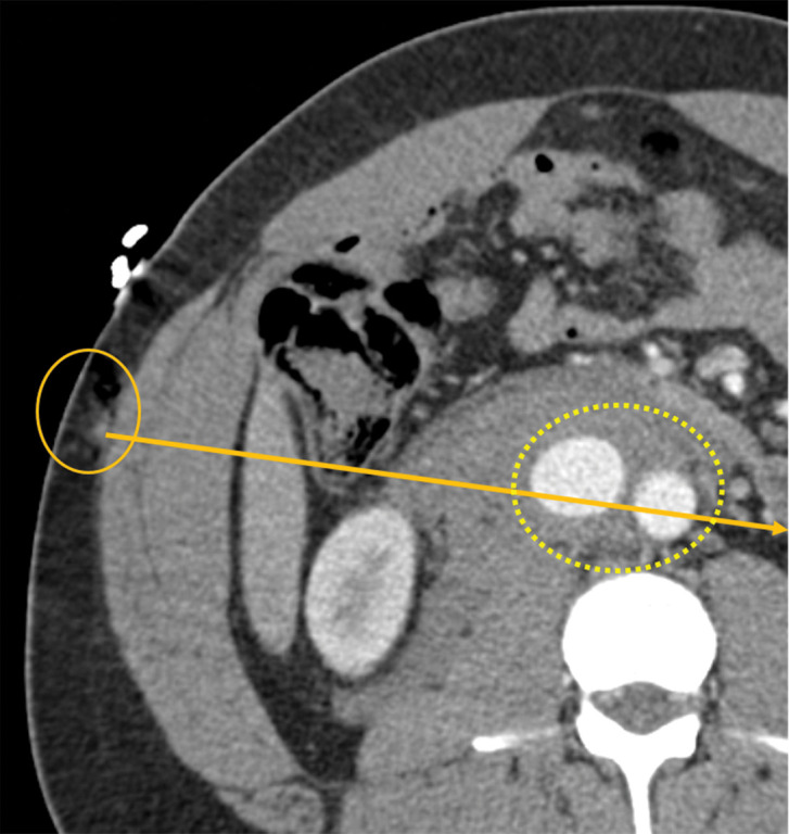 Direct and indirect signs of vascular injury in four patients. (a) Axial contrast-enhanced CT image of the abdomen and pelvis in a 34-year-old woman with a gunshot injury to the right flank demonstrates hematoma (circle) abutting the right renal artery (arrow) with vasospasm, which is suggestive of low-grade injury. (b) Axial contrast-enhanced CT image of the abdomen and pelvis in a 25-year-old man with a stab wound to the posterior flank from a long knife demonstrates right renal laceration with perinephric hematoma and a focal outpouching from the right renal artery (arrow), which are consistent with pseudoaneurysm. (c, d) Axial contrast-enhanced CT images of the abdomen and pelvis in a 19-year-old patient with a gunshot injury to the left back demonstrate hematoma in the retroperitoneum with vascular injuries to the aorta and inferior vena cava (obscured by streak from bullets) with active extravasation (arrow in d), suggesting vascular injury. (e) Axial CT image in a 27-year-old man with a gunshot injury to the right lateral abdomen (entry wound shown with solid orange oval) depicts a trajectory superimposed on the image (arrow) that traverses through the aorta and inferior vena cava, causing an arteriovenous fistula (dashed yellow oval).