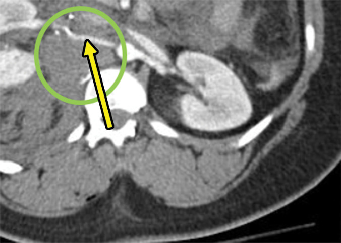 Direct and indirect signs of vascular injury in four patients. (a) Axial contrast-enhanced CT image of the abdomen and pelvis in a 34-year-old woman with a gunshot injury to the right flank demonstrates hematoma (circle) abutting the right renal artery (arrow) with vasospasm, which is suggestive of low-grade injury. (b) Axial contrast-enhanced CT image of the abdomen and pelvis in a 25-year-old man with a stab wound to the posterior flank from a long knife demonstrates right renal laceration with perinephric hematoma and a focal outpouching from the right renal artery (arrow), which are consistent with pseudoaneurysm. (c, d) Axial contrast-enhanced CT images of the abdomen and pelvis in a 19-year-old patient with a gunshot injury to the left back demonstrate hematoma in the retroperitoneum with vascular injuries to the aorta and inferior vena cava (obscured by streak from bullets) with active extravasation (arrow in d), suggesting vascular injury. (e) Axial CT image in a 27-year-old man with a gunshot injury to the right lateral abdomen (entry wound shown with solid orange oval) depicts a trajectory superimposed on the image (arrow) that traverses through the aorta and inferior vena cava, causing an arteriovenous fistula (dashed yellow oval).