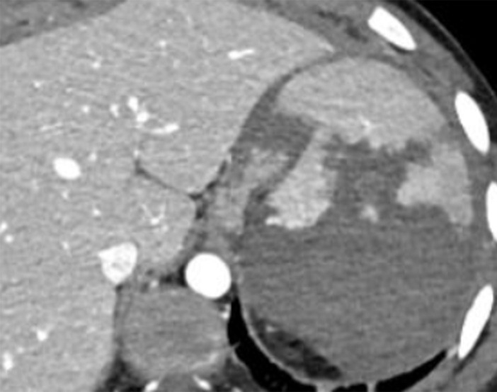 Descriptors of imaging features of splenic injury that may help in grading the splenic trauma, in addition to what has been described with liver injury patterns. Axial CT images demonstrate a shattered spleen (a) and a traumatic pseudoaneurysm (arrow in b).