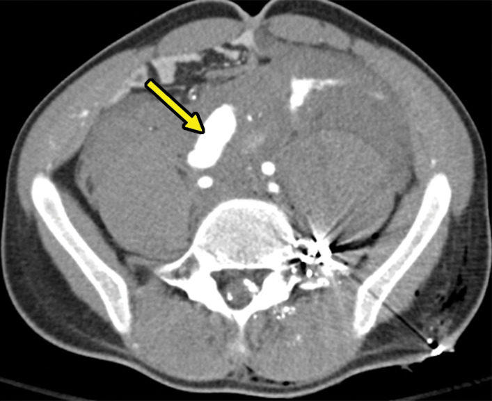 Direct and indirect signs of vascular injury in four patients. (a) Axial contrast-enhanced CT image of the abdomen and pelvis in a 34-year-old woman with a gunshot injury to the right flank demonstrates hematoma (circle) abutting the right renal artery (arrow) with vasospasm, which is suggestive of low-grade injury. (b) Axial contrast-enhanced CT image of the abdomen and pelvis in a 25-year-old man with a stab wound to the posterior flank from a long knife demonstrates right renal laceration with perinephric hematoma and a focal outpouching from the right renal artery (arrow), which are consistent with pseudoaneurysm. (c, d) Axial contrast-enhanced CT images of the abdomen and pelvis in a 19-year-old patient with a gunshot injury to the left back demonstrate hematoma in the retroperitoneum with vascular injuries to the aorta and inferior vena cava (obscured by streak from bullets) with active extravasation (arrow in d), suggesting vascular injury. (e) Axial CT image in a 27-year-old man with a gunshot injury to the right lateral abdomen (entry wound shown with solid orange oval) depicts a trajectory superimposed on the image (arrow) that traverses through the aorta and inferior vena cava, causing an arteriovenous fistula (dashed yellow oval).