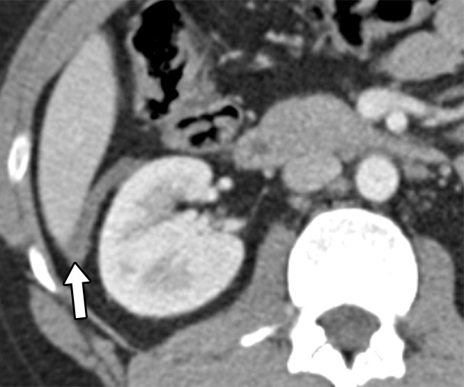 Axial contrast-enhanced CT images of the abdomen and pelvis in a 56-year-old man with gunshot trauma to the abdomen show simple attenuating free fluid (arrow) in the dependent portions, which are the cul-de-sac (a) and Morison pouch (b).