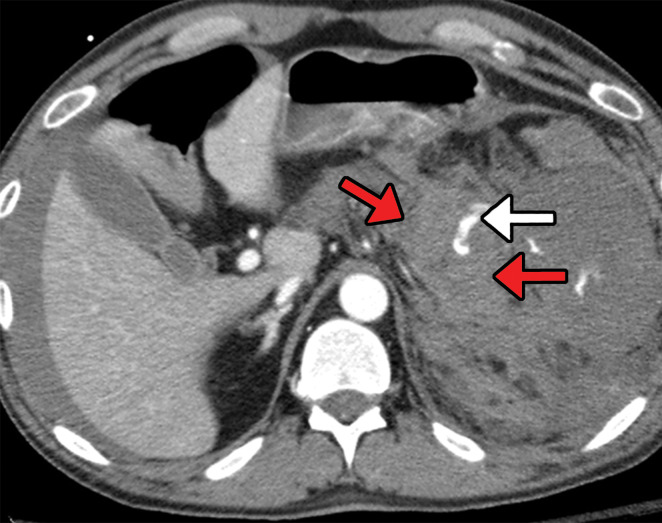 Multiple gunshot wounds with pancreatic transection in a 40-year-old man. (a) Axial contrast-enhanced CT image of the abdomen and pelvis demonstrates pancreatic laceration (red arrows) with active extravasation (white arrow), indicating direct signs of pancreatic injury. (b) Axial contrast-enhanced CT image shows extensive peripancreatic stranding extending toward the splenic hilum (yellow arrows), which is an indirect sign of pancreatic injury.