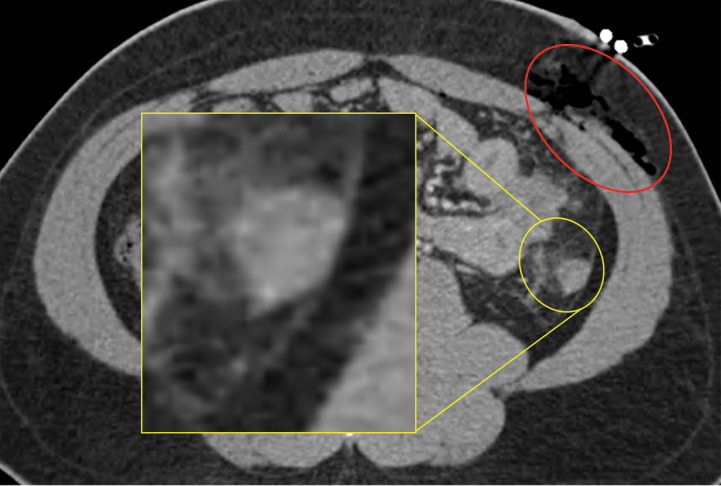 Gunshot injury in a 21-year-old man. Axial contrast-enhanced CT images of the abdomen and pelvis demonstrate foci of gas within the subcutaneous fat, indicating the entry wound (yellow circle in a) and exit wound (red oval in b). In the path of the bullet trajectory (not double oblique orientation), there is evidence of bowel injury, as indicated by focal bowel wall thickening and surrounding stranding (yellow circle in b), which is magnified for clarity (inset in b).