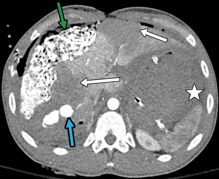 Multiple gunshot-related injuries in a 21-year-old patient who was taken to the operating room for initial exploratory laparotomy. Axial CT images reveal packing material (green arrow in a) with an open abdomen (yellow arrow in b). The image obtained after surgical exploration (b) demonstrates thickened bowel walls with hyperenhancement (red arrows), which are likely secondary to hypoperfusion. A bleeding pseudoaneurysm (blue arrow in a) in hepatic segment 7 is demonstrated, which was subsequently coil embolized (not shown). Also note segmental liver infarctions (white arrows in a) and large-volume hematoma (☆ in a). This finding (bleeding pseudoaneurysm) was not appreciated at exploratory laparotomy.