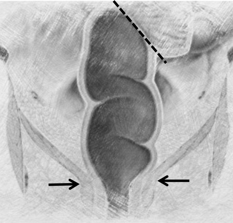 Diagram of anorectal anatomy demonstrates the proximal aspect of the rectum, which is defined by the confluence of the tenia coli muscles along the serosal aspect of the sigmoid colon (dashed line). The anorectal junction is at the dentate line (arrows), which is roughly inferred by the position of the levator ani muscle. Rectal anatomy is pertinent when interpreting CT images, as the level of injury may change management.