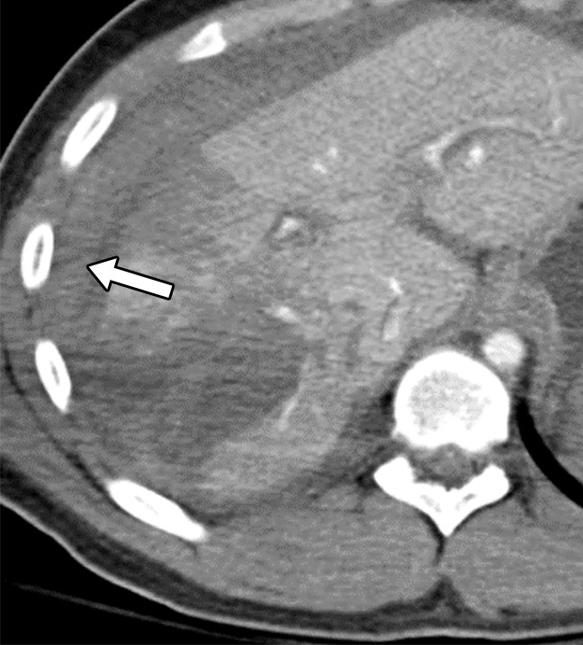 Axial CT images of the abdomen and pelvis in a 38-year-old man with penetrating trauma to the chest and abdomen demonstrate two manifestations of hemoperitoneum with the sentinel clot sign (arrow in a) and the hematocrit effect (arrow in b).