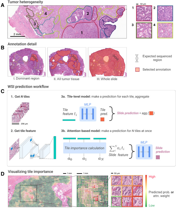 Figure 1. Overview of the deep learning workflow. A, Expert-based annotations of tumor regions reveal tumor heterogeneity. Left, regions with different grade are annotated in different colors. Right, enlarged views from four annotated regions with different grade. B, Three types of annotation detail can be evaluated, whether to only include the dominant region, all tumor tissue, or the whole slide. C, N tiles are extracted from the selected annotation and a ResNet-18 model extracts features for individual tiles. Then, either the tile-level or attention-based model is trained to make predictions for the presence of TP53 mutations (trained end-to-end with ResNet). D, Visualizing the tile-level probabilities from the tile-level model or attention weights per tile from the attention-based model on the original WSI gives an indication of the predicted spatial location of TP53 mutations.