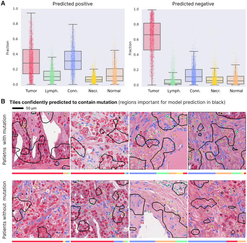 Figure 5. Predominant cell types in tiles predicted with and without a TP53 mutation. A pretrained network from HoverNet (56) was used to simultaneously detect and classify cells in tiles predicted to (not) contain a TP53 mutation. A, Fraction of detected cell types within tiles for 2,000 tiles that were most confidently predicted to contain a TP53 mutation (left) and not to contain one (right). B, For distinct patients, the tile that was most confidently predicted to contain a mutation. Shown for 10 patients with mutation (top) and 10 patients without mutation (bottom). Regions found to be important for the model prediction are encircled in black [obtained by calculating the contour of GradCam (57) heatmaps on the original tile]. The bar below the plot shows for every tile the fraction of cell types within the black regions (color code same as in A).