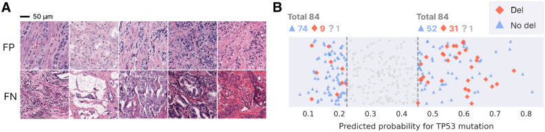 Figure 4. Interpretation of model mistakes. A, Mistakenly predicted tiles, predicted to contain a mutation (top) and no mutation (bottom). B, For patients without mutation, predicted probability for patients with (red) and without (blue) deletion in the 0.25 and 0.75 quantile. Patients whose deletion status is unknown are not shown in the figure, but are indicated on top (“?”).