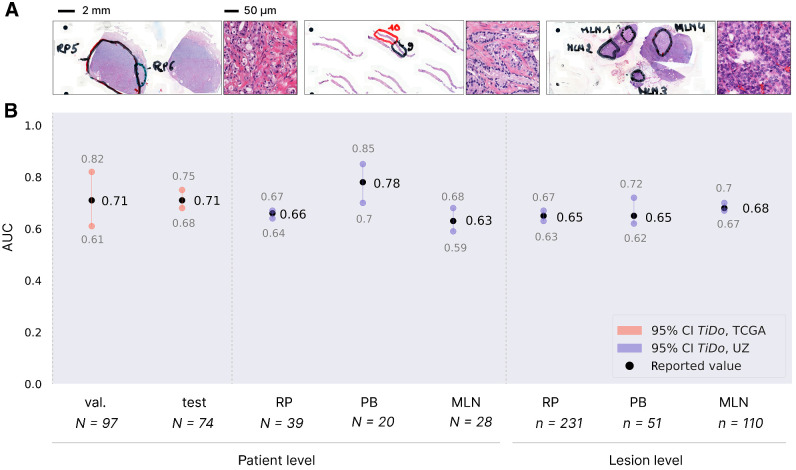 Figure 3. Performance evaluation of independent cohort. A, Exemplary slides and tiles for RP (top), PB (middle), and MLN (bottom) samples. The two annotated regions in the RP sample represent two sequenced tumor lesions (same for the two PB and four MLN lesions). B, Generalization performance of model. Red, previously reported performance of TiDo on TCGA-PRAD; purple, generalization performance of TiDo. Results were aggregated over the six times repeated cross-validation.