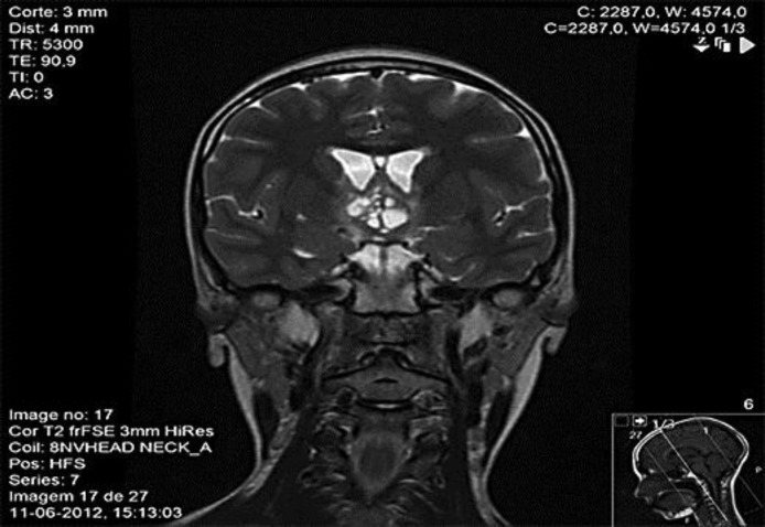 Adipsia In A Diabetes Insipidus Patient PMC pin-von-mothertheresa-auf-crafty