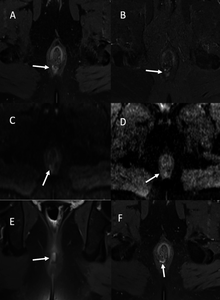 Diffusion-Weighted MRI in Perianal Abscess: Role and Comparison With ...