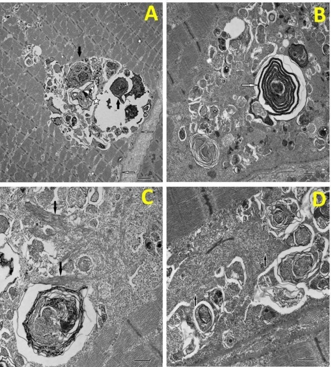 Slowly progressive distal muscle weakness: neuropathy or myopathy? - PMC