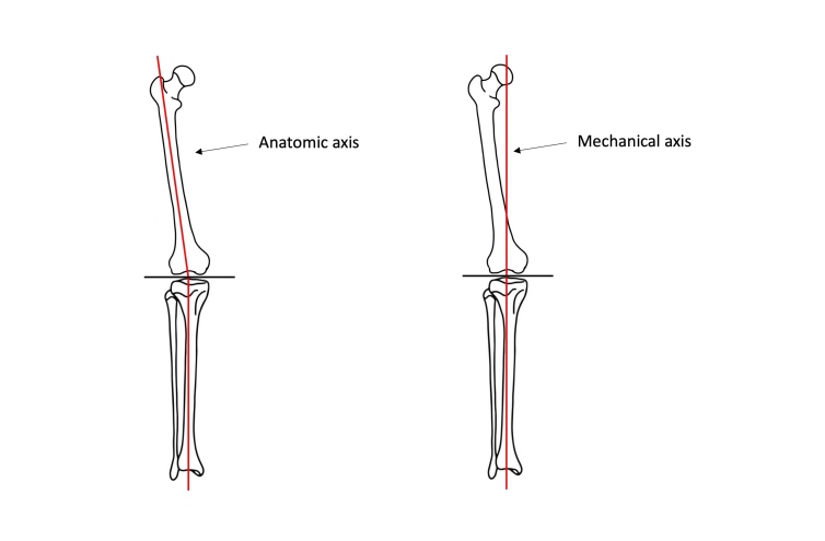 Figure 1. Anatomic axis (left) and mechanical axis (right).