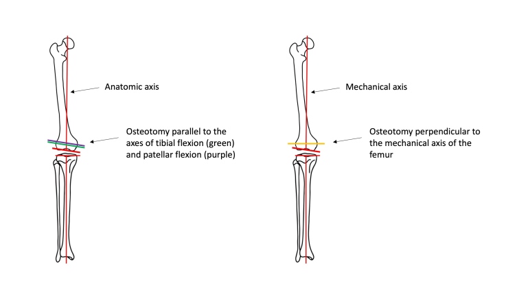 Figure 2. Comparison of femoral osteotomy in kinematic alignment (left, parallel to purple and green axes) and mechanical alignment (right, in yellow). Image modified from Hirschmann et al.19