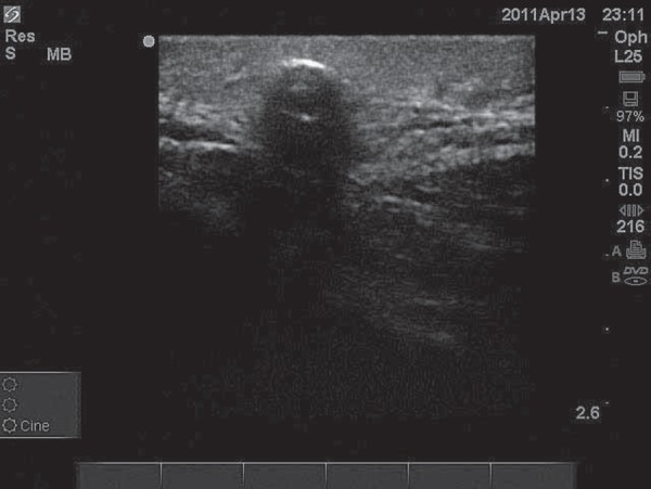 Bedside emergency department ultrasound in assessment of a gunshot ...