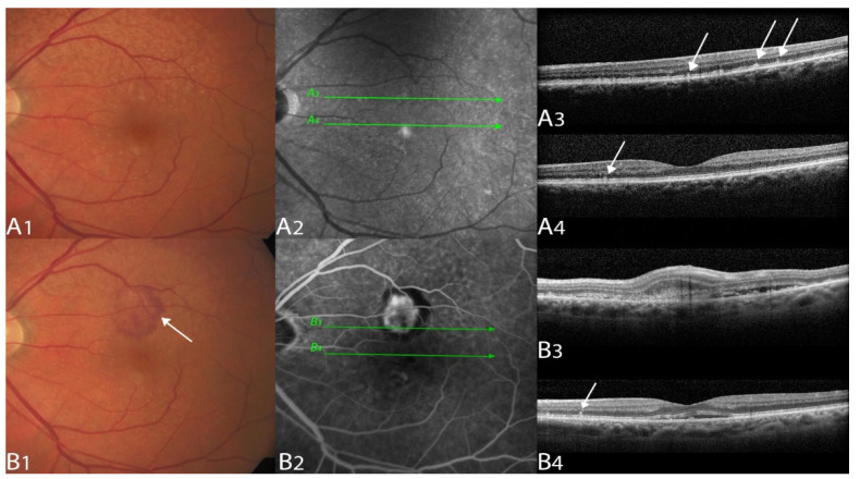 Correlation between Macular Neovascularization (MNV) Type and Druse ...