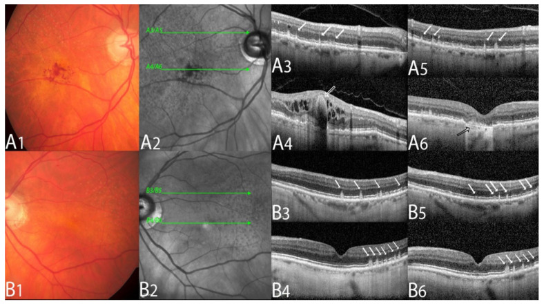 Correlation between Macular Neovascularization (MNV) Type and Druse ...